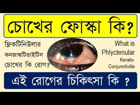 Phlyctenulosis: causes, symptoms and treatment. # Phlyctenulosis # Phlyctenularconjunctivitis ...