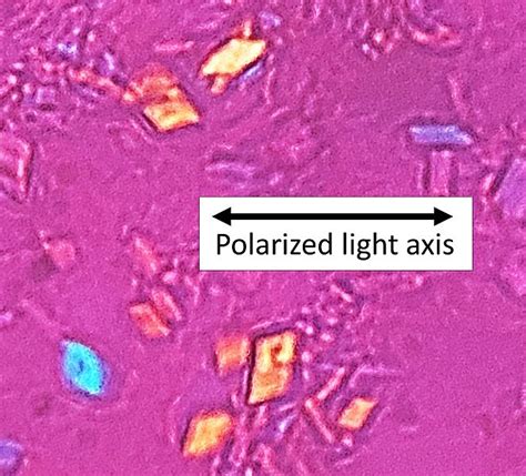 Image: Birefringence microscopy of pseudogout, annotated