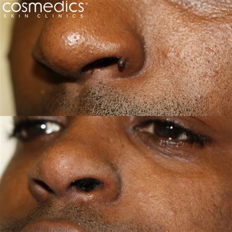 Wart Removal London and Bristol | Cosmedics Skin Clinics