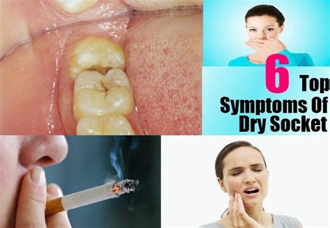 Top 6 Symptoms Of Dry Socket And Wisdom Teeth | Top wisdom teeth ...