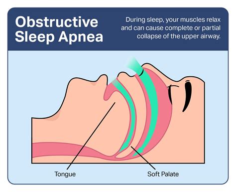 Obstructive Sleep Apnea: Symptoms, Causes, and Treatments