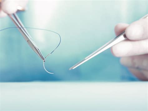 Ob/Gyn Updated : Sutures are better than staples in third or high-order ...