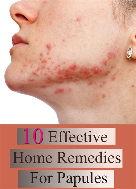 10 Effective Home Remedies For Papules | Search Home Remedy