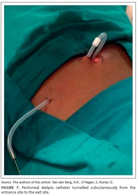 Percutaneous placement of peritoneal dialysis catheters in resource-limited developing countries ...