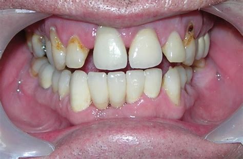 Dental Veneers | Treatment for Fractured Teeth Bangalore | India