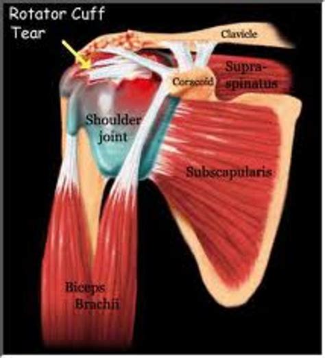 How To Stop Torn Rotator Cuff Shoulder Pain- Rotator Cuff Treatments ...