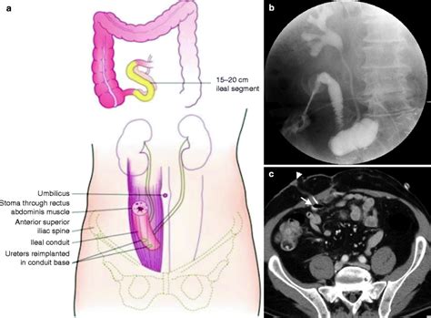 Imaging of Urinary Diversion and Neobladder | Radiology Key