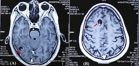 What Is Cysticercosis? | Healthtian