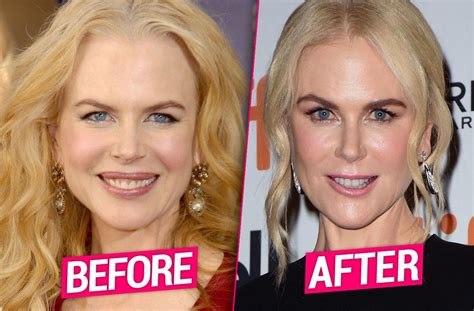 Nicole Kidman’s Plastic Surgery Transformation -- Top Docs Claim ...