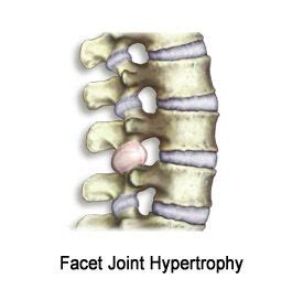 Facet Hypertrophy L5-S1 | Facet Joint Hypertrophy | Facet, Joint, Syndrome