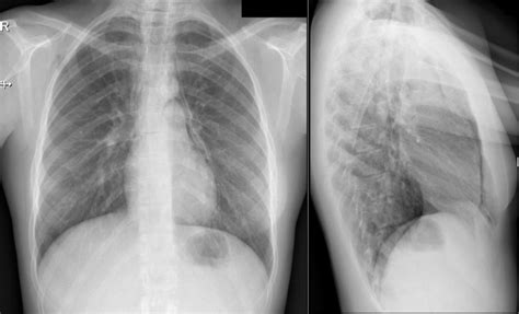 Hamman’s crunch: a forgotten clue to the diagnosis of spontaneous pneumomediastinum | BMJ Case ...