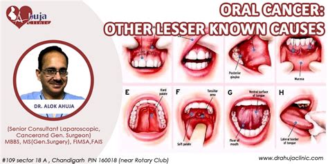 Floor Of Mouth Cancer Causes And Effects | Viewfloor.co