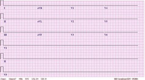 Asystole ECG | LearntheHeart.com