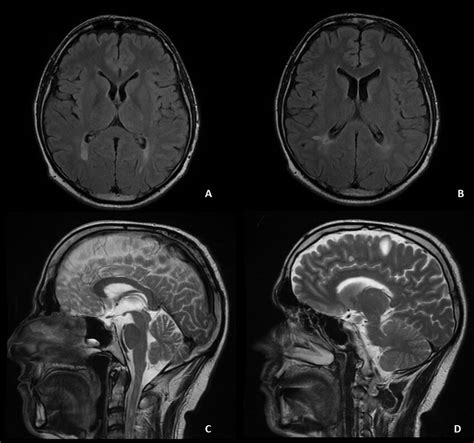 A-B) Axial cross-section MRI images of the brain on FLAIR sequence,... | Download Scientific Diagram