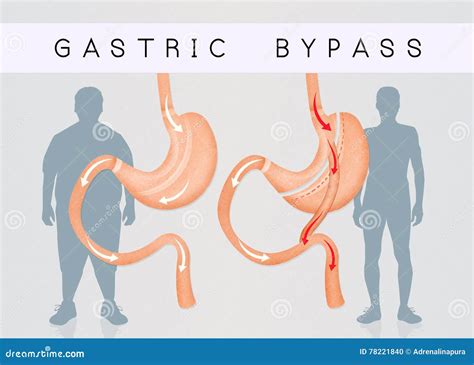 Gastric Bypass And Gastric Band Stock Image | CartoonDealer.com #82452793