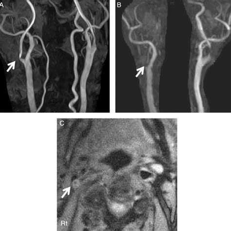 MRA showed bilateral ICA stenosis (A) and after 7 months, MRA revealed ...