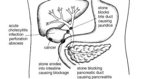 Gallbladder Stone: Complications