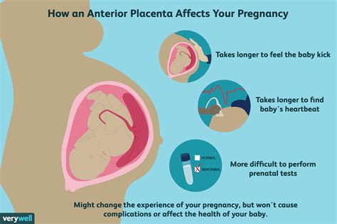 What It Means to Have an Anterior Placenta