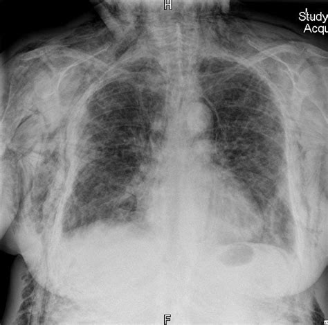 Subcutaneous emphysema | Radiology Case | Radiopaedia.org | Radiology ...