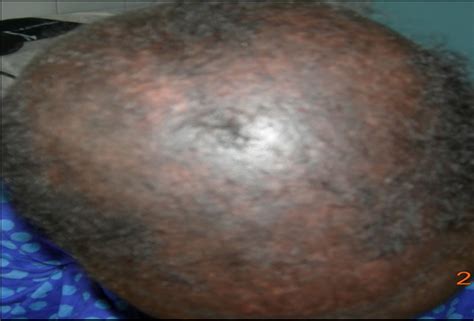 The Scalp Involvements in the Connective Tissue Diseases