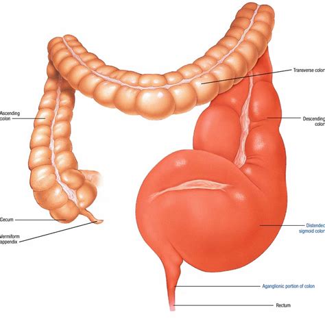 Hirschsprung’s disease Symptoms and Treatment | Mediologiest