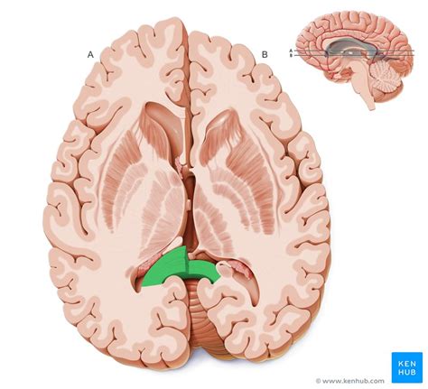 Horizontal sections of the brain: Anatomy | Kenhub