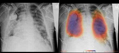 Chest X-Ray, COVID-19 Patient, [IMAGE] | EurekAlert! Science News Releases