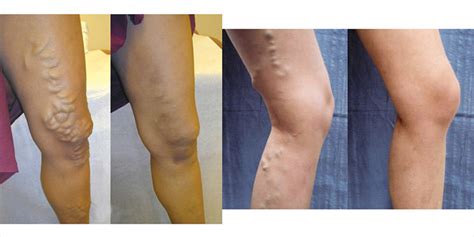 Varicose Veins Treatment: A Q&A with UCSF Interventional Radiologists | UCSF Radiology