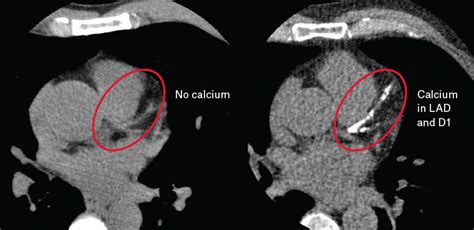 RACGP - Coronary artery calcium in primary prevention