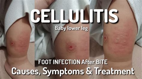 Cellulitis Baby