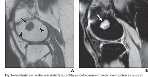 Incidental enchondromas of the knee. | Semantic Scholar