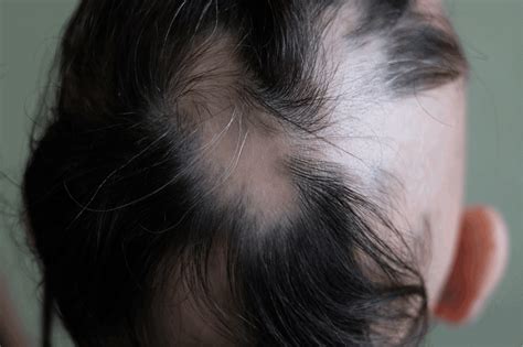 3 signs of regrowth in alopecia areata | Lady Alopecia