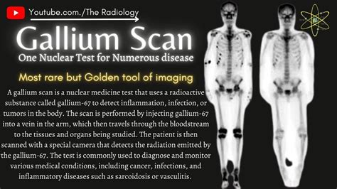 What is Gallium Scan #unknowninfections #sarcoidosis #cancer #tumors - YouTube