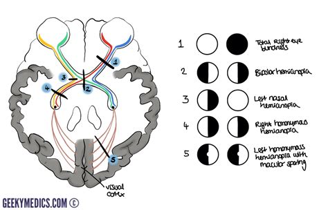 The Optic Nerve (CN II) | Cranial Nerve II | Geeky Medics