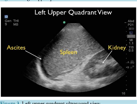 Figure 5 from Ultrasound for Detection of Ascites and for Guidance of ...