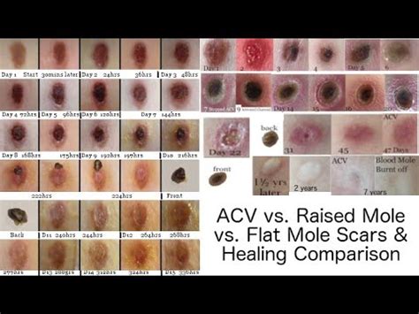 ACV mole removal scars & healing comparison part 2 Flat vs. Raised mole - YouTube