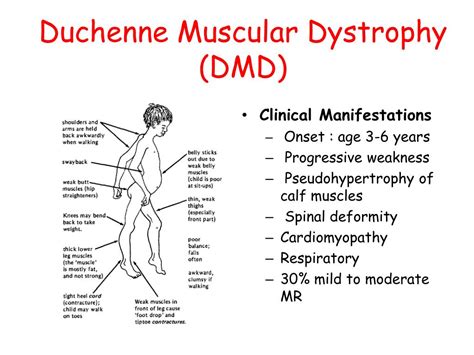 What Is Duchennes Muscular Dystrophy Duchennes Muscular Dystrophy ...