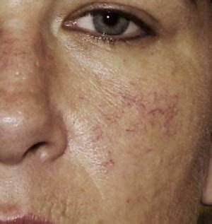 Causes of Rosacea: Vascular Changes | Rosacea.org