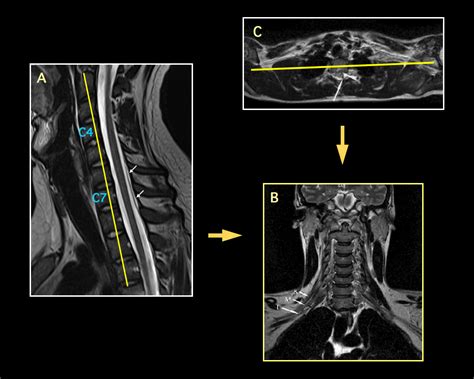 Brachial Plexus Anatomy Mri