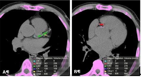 Calcium scoring (CAC) performed on a non-contrast ECG-gated CT scan of... | Download Scientific ...