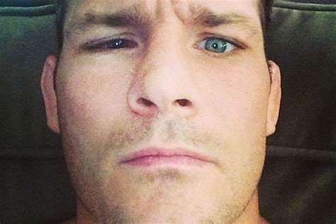 Pic: Michael Bisping posts photo of eye recovery following detached retina - MMAmania.com