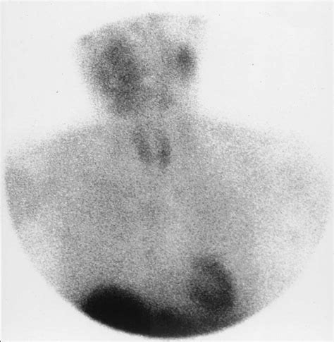 Postperative 99m-Tc MIBI nuclear scan revealing no focus of increased... | Download Scientific ...