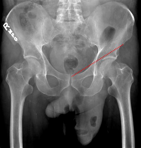 Left Side Inguinal Hernia