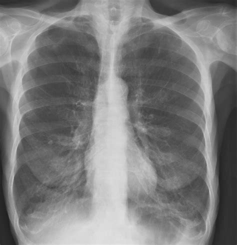 [Figure, X-ray, COPD, Chronic Obstructive Pulmonary...] - StatPearls ...