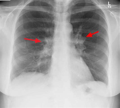 Right Hilar Lymph Node Enlargement, Location, Metastasis, Calcification