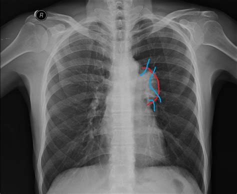 Chest Medicine Made Easy-Dr Deepu: Signs in chest radiology- The hilum ...