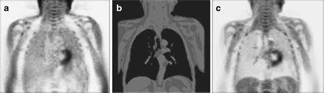 Soft-tissue attenuation correction (AC) of PET images based on MRI ...