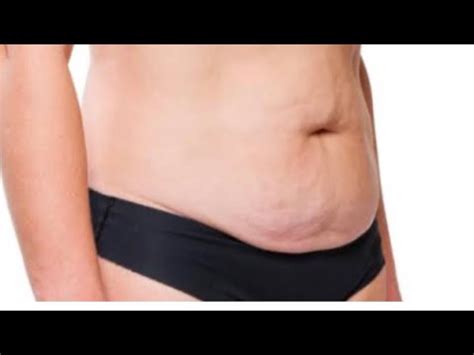 Vaser liposuction 4 D MUMBAI DELHI AHMEDABAD INDORE LUCKNOW NAGPUR - YouTube