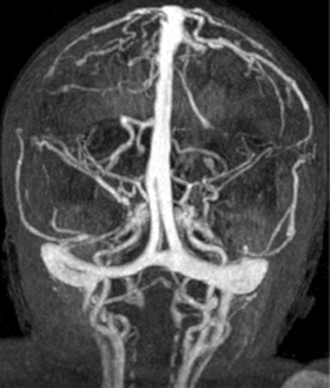 Transverse Sinus Mri