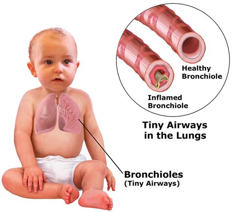 Bronchiolitis causes, prevention, symptoms, diagnosis and treatment